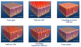 Remodelage par laser non ablatif 2